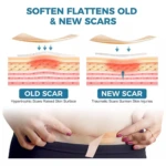 Parche de Silicona Cesárea Reduce Cicatriz 4cm x 1,5mt