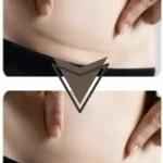 Parche de Silicona Cesárea Reduce Cicatriz 4cm x 1,5mt